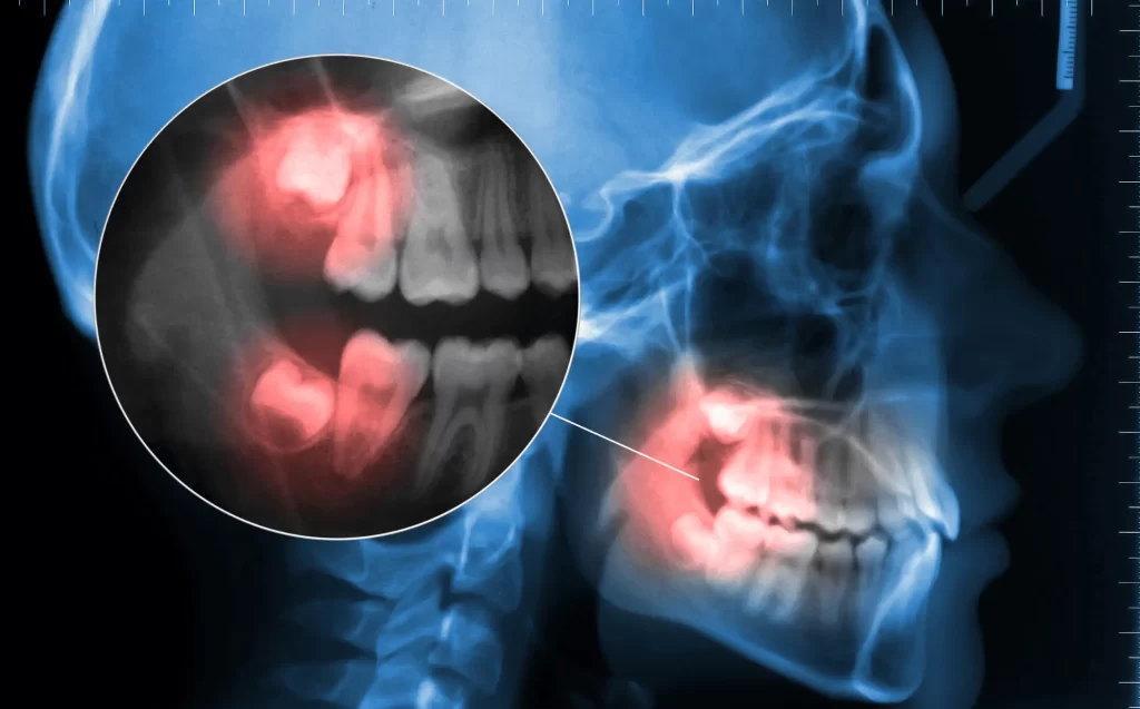 Radiografía sobre si extraer las cordales