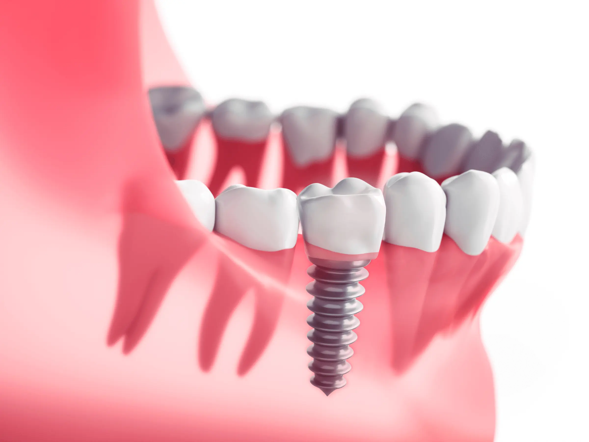 implantes dentales